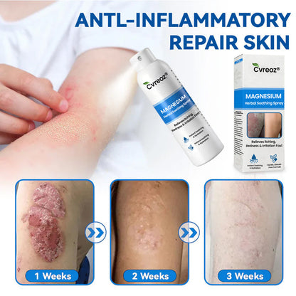 🔥Final 3 Hours: 80% OFF:Cvreoz® Magnesium Herbal Psoriasis Spray⚕️ FDA Certified (for the treatment of psoriasis and eczema, improvement of bacterial infections in the genital area, treatment of acne and warts, eliminates psoriasis and eczema, etc.)