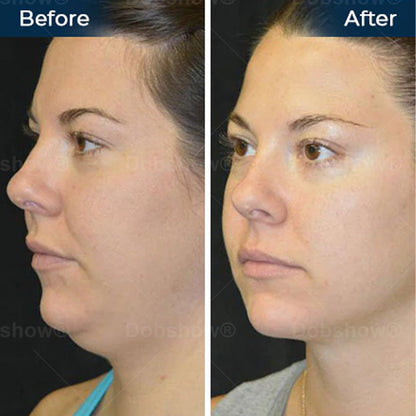Nurbini® Sleeping V-Face Beauty Device