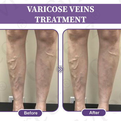 Cvreoz®DiaLeg Care Phyto Cream