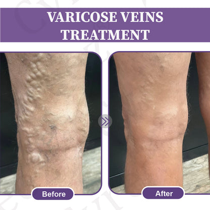 Cvreoz®DiaLeg Care Phyto Cream