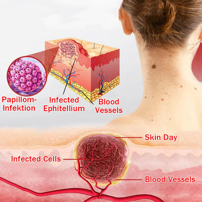 Cvreoz®MicroNeedle BotanicSkin Tag Removal Patch