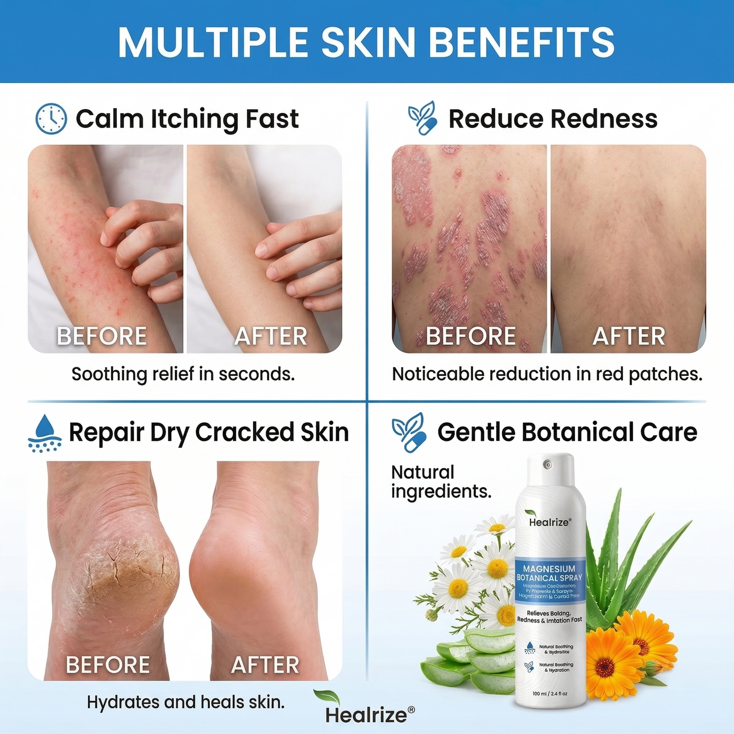 🏆Healrize® Magnesium Botanical Spray –Advanced Skin Recovery for Psoriasis & Eczema | Rapid Soothing, Steroid-Free