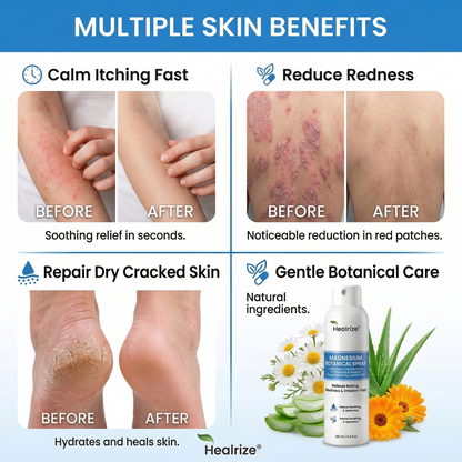 🏆Healrize® Magnesium Botanical Spray –Advanced Skin Recovery for Psoriasis & Eczema | Rapid Soothing, Steroid-Free