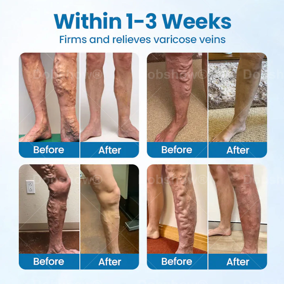 Cvreoz® VeinGuard Herbal Spray-✅ Clinically proven to eliminate varicose veins in just 7 days!