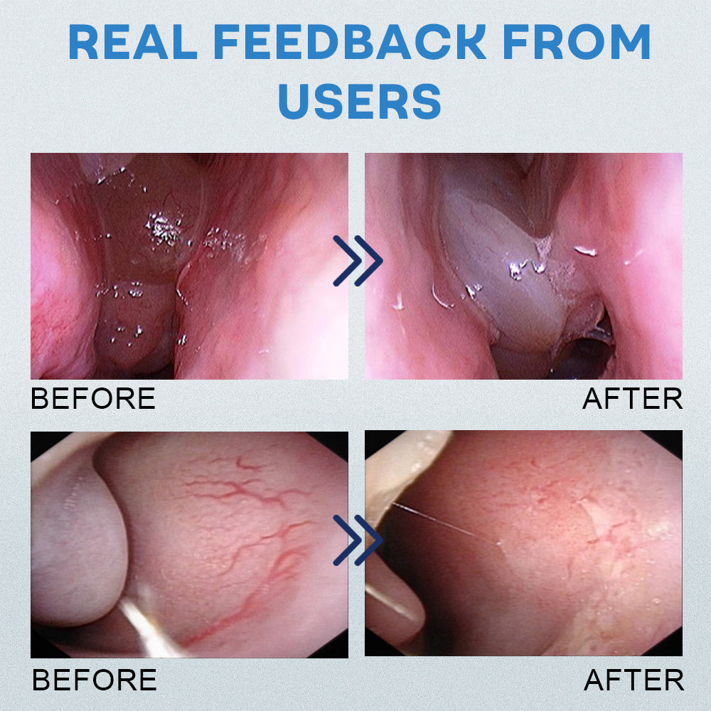Mresio® Allergic Rhinitis Relief Device