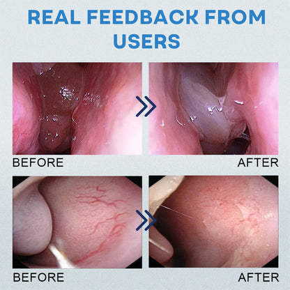 Mresio® Allergic Rhinitis Relief Device