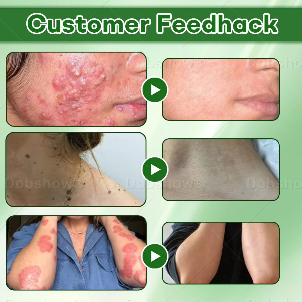 AAFQ®Tea Tree Oil Clarifying Therapy Cream✅𝐅𝐃𝐀-𝐀𝐏𝐏𝐑𝐎𝐕𝐄𝐃 – Removes Skin Blemishes, Repairs Damaged Skin, Brightens & Anti-Ageing Care