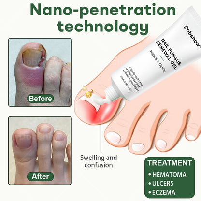Dobshow® Nail Fungus Renewal Gel