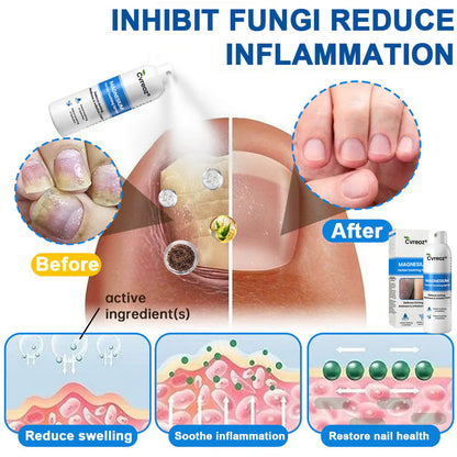 🔥Final 3 Hours: 80% OFF:Cvreoz® Magnesium Herbal Psoriasis Spray⚕️ FDA Certified (for the treatment of psoriasis and eczema, improvement of bacterial infections in the genital area, treatment of acne and warts, eliminates psoriasis and eczema, etc.)